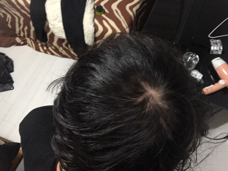 smp 체험단 정종민 수술 전 (2).jpg