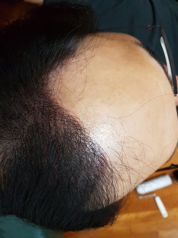 시술후_집.jpg