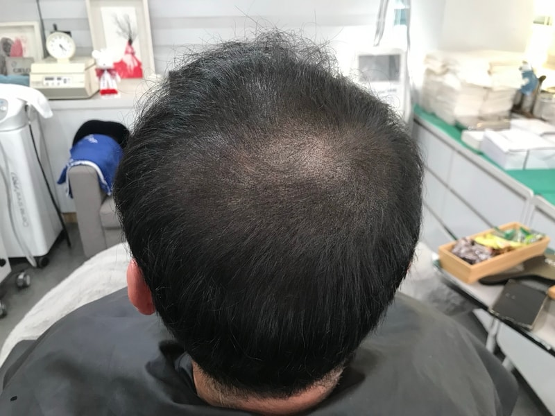 두피문신후1.jpg