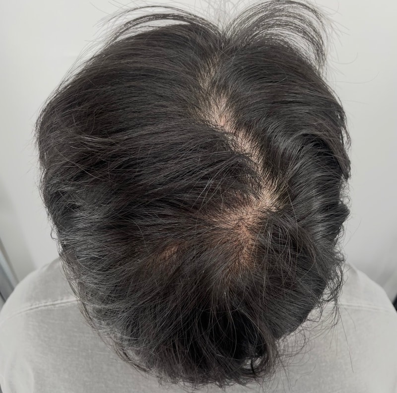 江南NEWHAiR 植发中心头皮纹身第2集后记令人满意