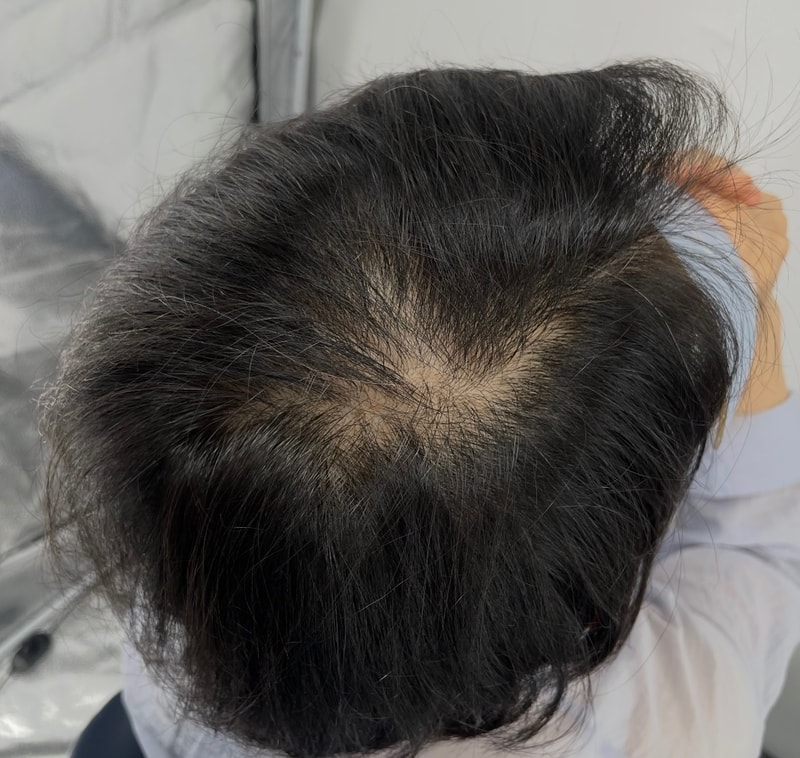 뉴헤어 두피문신 후기  정수리 가마 부분이 머리숱이 없어 오랜시간 고민만 하다 큰 용기를 내