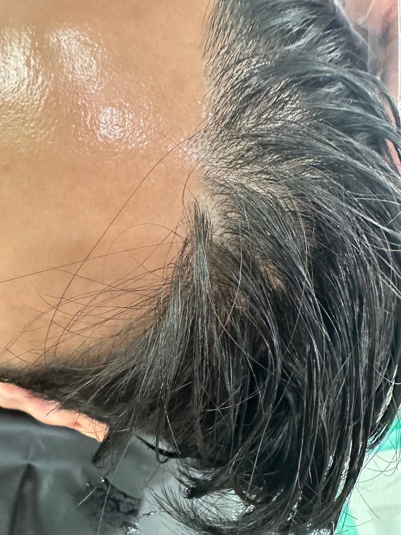 연세미다인 헤어라인 두피문신 1회차 후기 