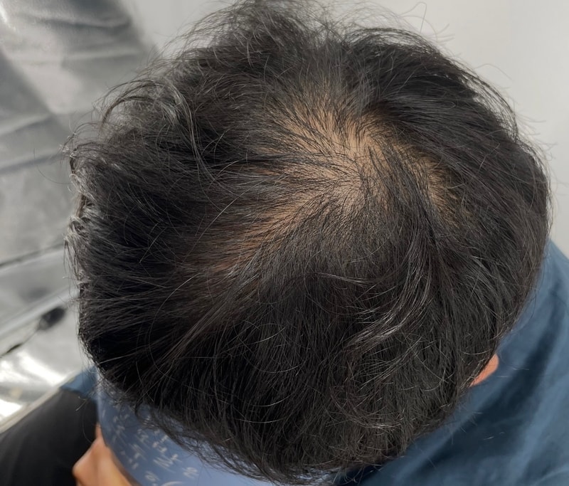 5年来一直戴着黑发，对头皮纹身一直很苦恼。 总之，今天在江南NEWHAiR 植发中心进行了第2次头皮纹身，满意度很高。