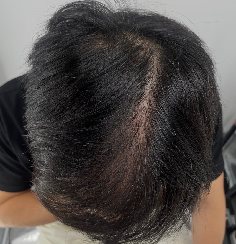 纹了三次头皮 在江南NEWHAiR 植发中心接受之前能看到很多头皮，但是接受第三次后变暗了，一般都看不到头皮了。