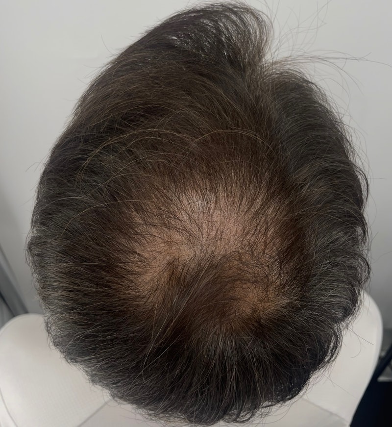 下了很大决心，整个头顶都纹了头皮。 江南NEWHAiR 植发中心