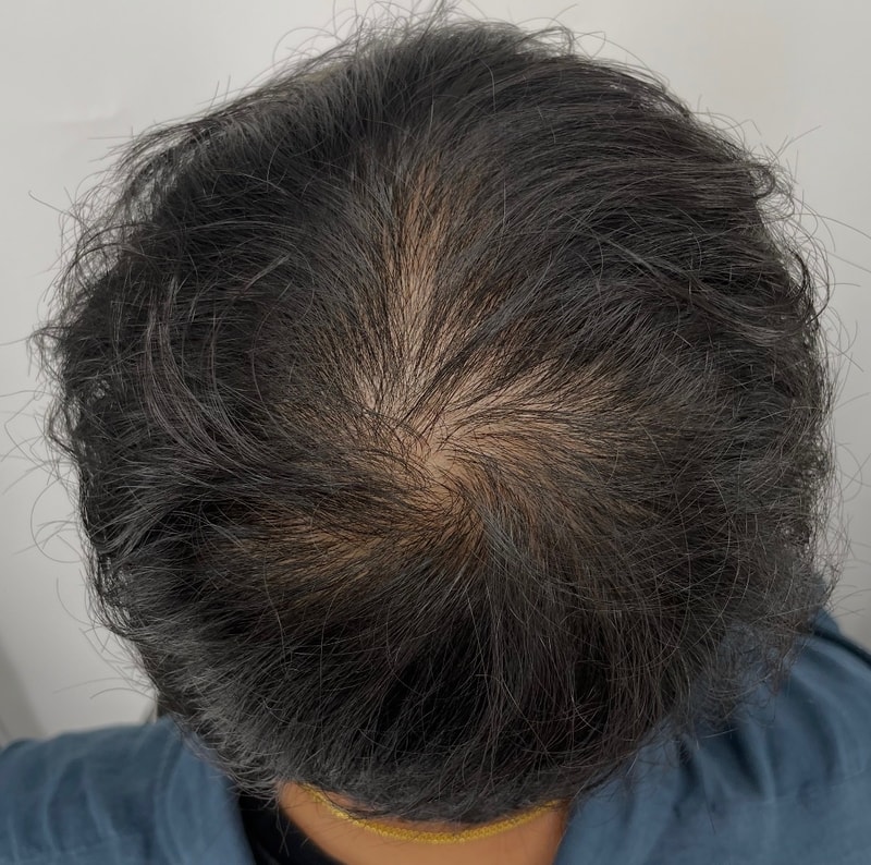 今天完成了第3次江南NEWHAiR 植发中心头皮纹身手术。 总之，不用黑菜，满意度最高。