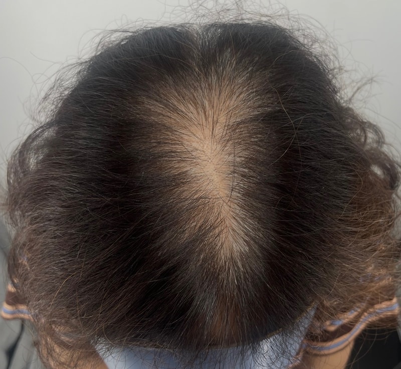在江南NEWHAiR 植发中心接受头皮纹身手术后感觉很好