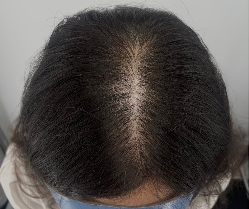 推荐江南NEWHAiR 植发中心头皮纹身！