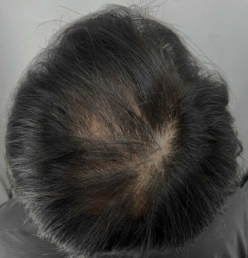 NEWHAiR 植发中心解决掉头顶脱发头皮纹身问题（2次）