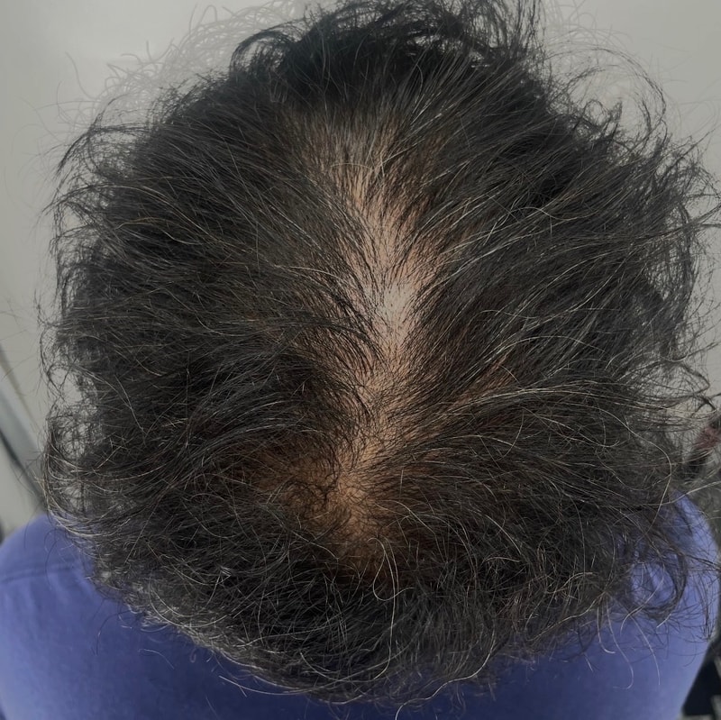 在江南NEWHAiR 植发中心收到了头皮纹身。