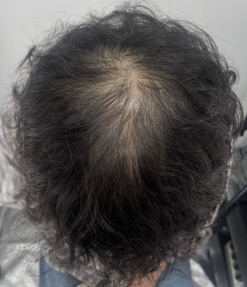 NEWHAiR 植发中心的头皮纹身质量不一样！