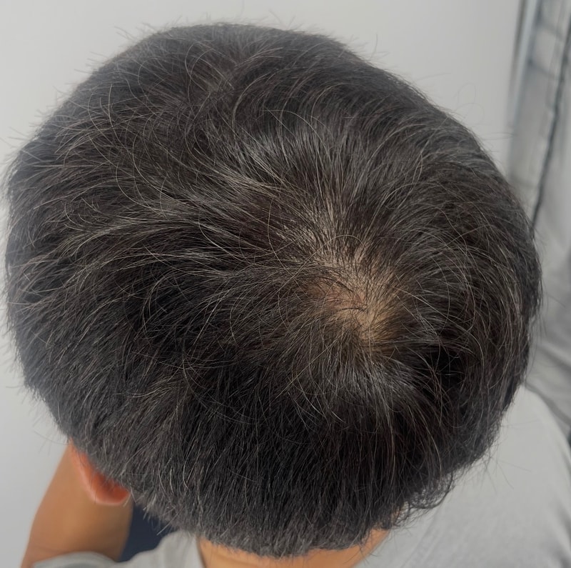 싱가포르에서 지내다가 한국 방문 일정에 맞춰 강남 뉴헤어의원에서 정수리 두피문신을 받았습니다.
