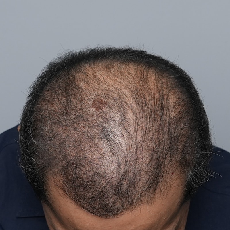 그레이시티 모발이식 생착 실패 후 문신 1회차