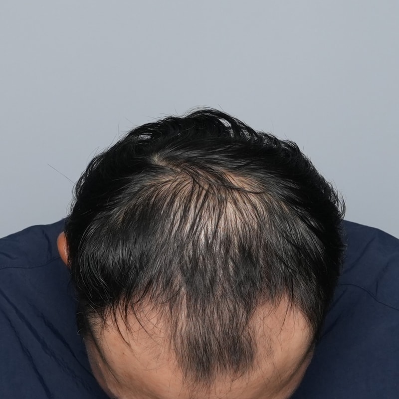 전체 두피문신 2회차 그레이시티 후기