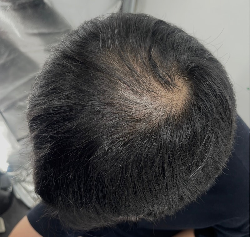 정수리 고민 끝에 강남 뉴헤어를 방문하게 되었고 두피문신 시술을 추천 받았습니다.