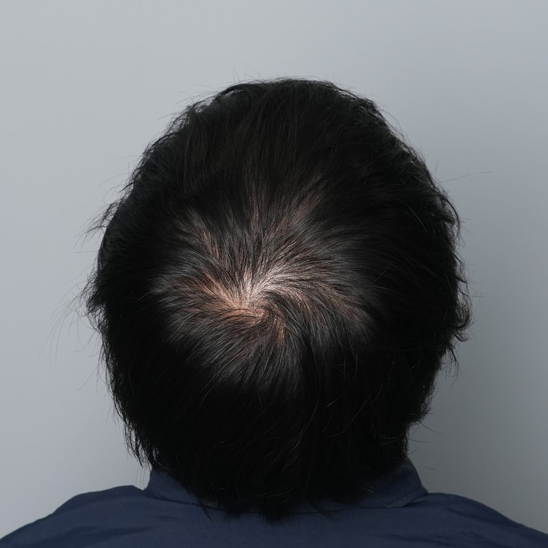 정수리 가르마 그레이시티 문신 후기입니다ㅜ