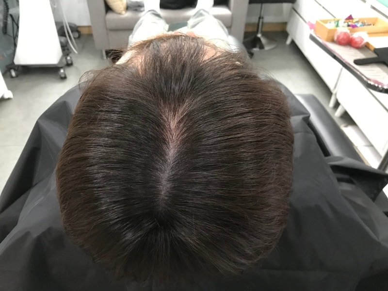[연세미다인] 두피문신 후기