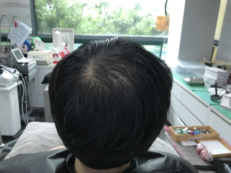 연세미다인 두피문신 후기입니다~