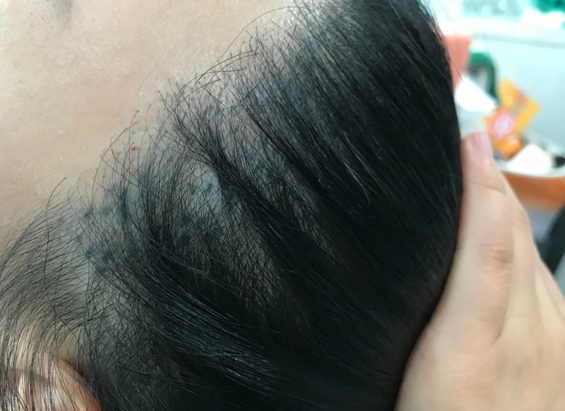 두피문신실패후 제거후기(연세미다인의원)