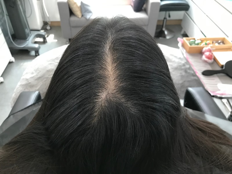 연세미다인 두피 문신