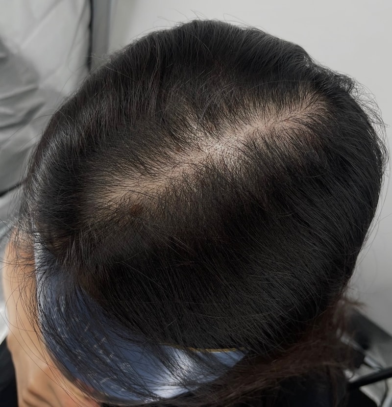 뉴헤어 두피문신 하고 나니 흑채 안 해도 될 생각에 너무 편하고 좋아요! 