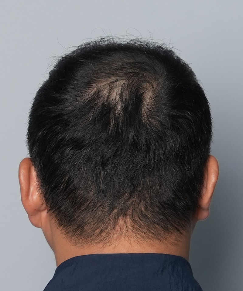 그레이시티 남자 깊은 m자 상담 후기