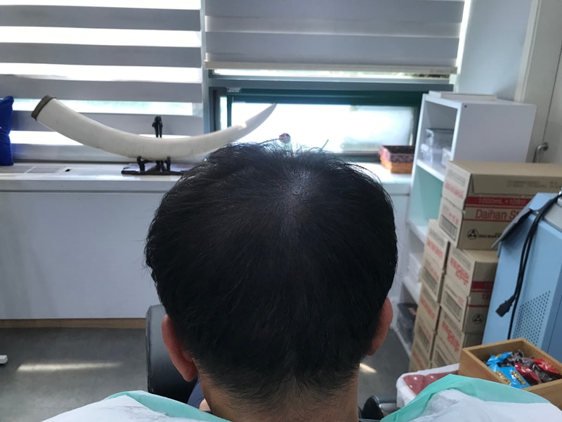 연세미다인 시술 2달 후 리터치
