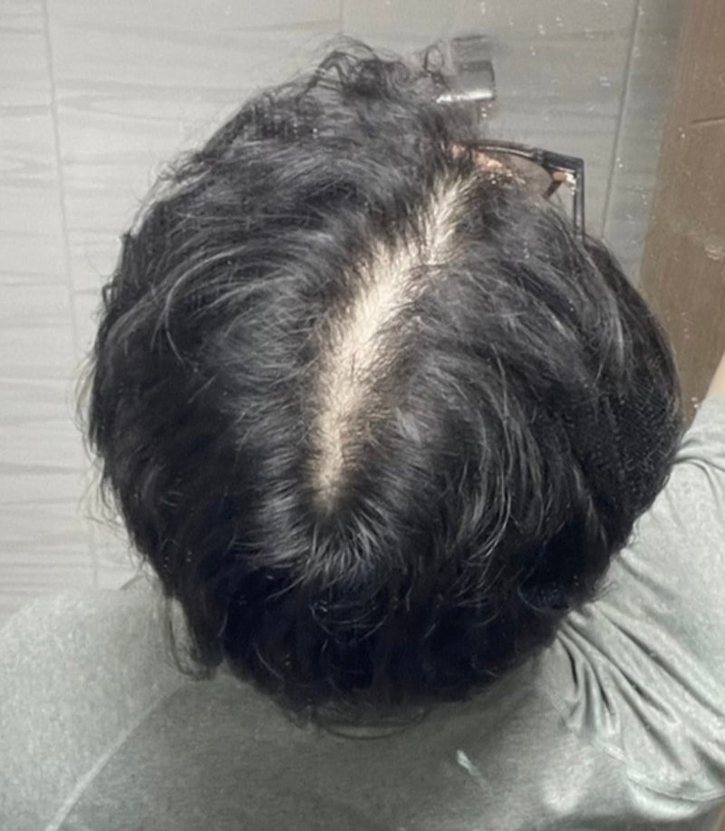 Smp 두피문신 3회차 후기 공유합니다!