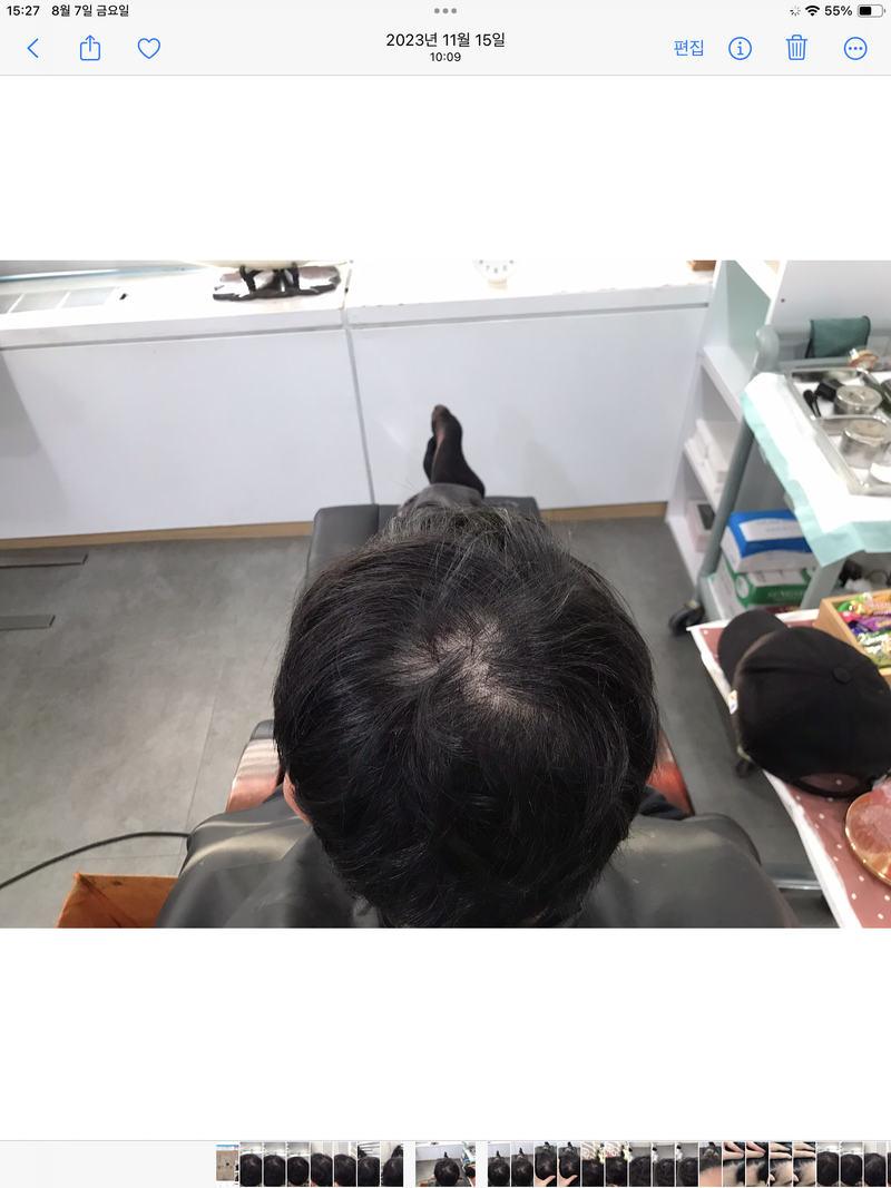 연세미다인 두피문신 4년 후기