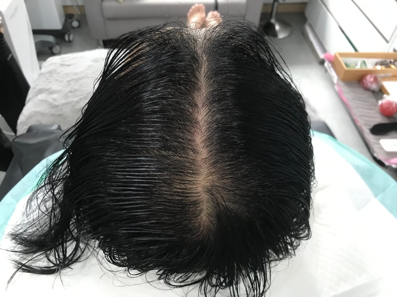 [연세미다인] 그라데이션 기법 이용한 두피 문신 후기입니다. 