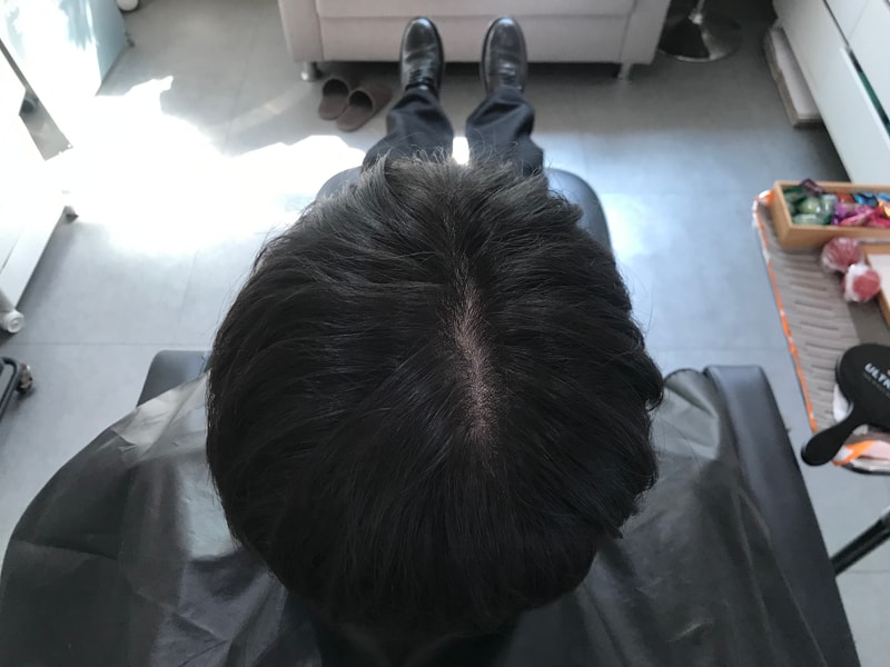 연세미다인 두피문신 후기