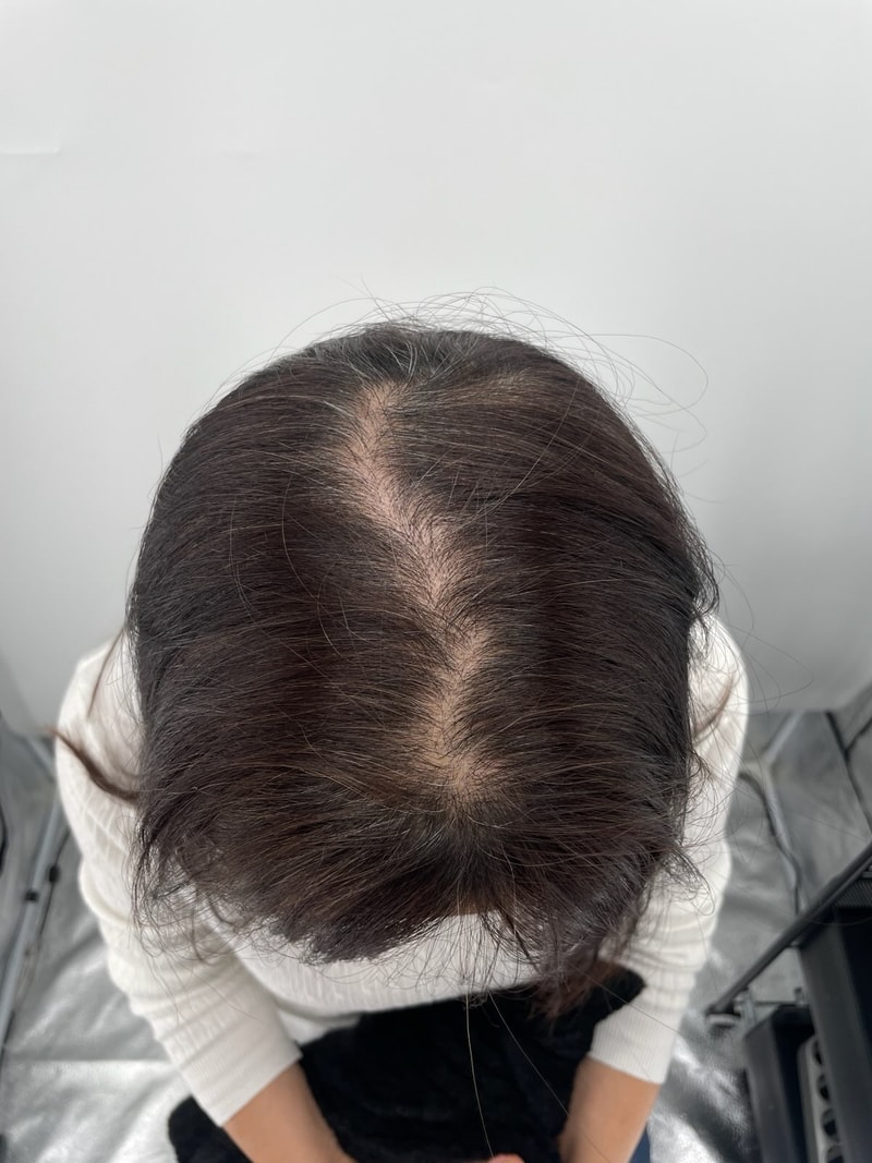 탈모가 고민돼서 강남 두피문신 병원을 정말 오래 비교한 끝에 드디어 가르마 시술을 받았어요.