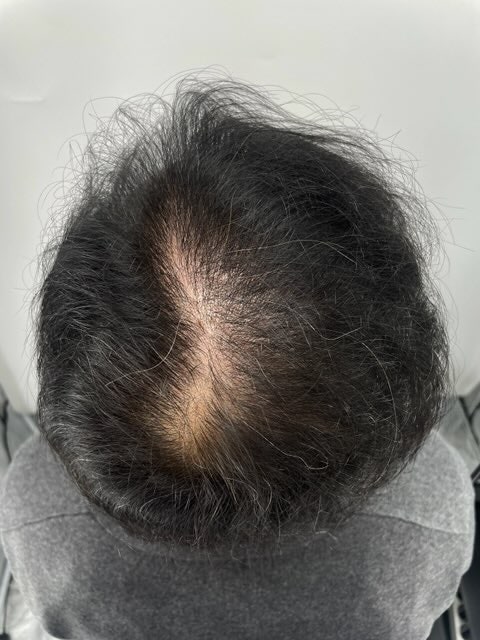 강남 두피문신 병원 뉴헤어성형외과에서 두피문신을 받은 후, 이제는 진짜 흑채를 손에 잡을 일이 없어졌습니다.