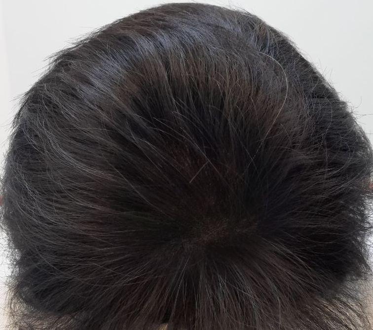 정혁상-모발이식-후.png