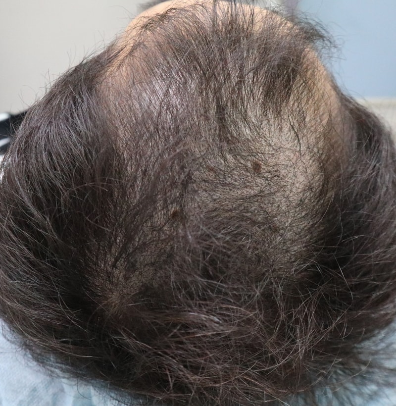 최용환-두피문신-전.jpg