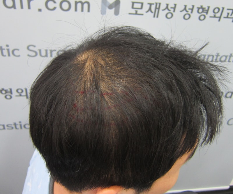 시술전3.JPG