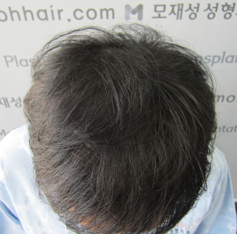 시술직후 1.JPG