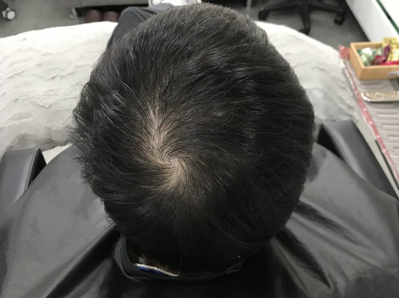 정수리 두피문신 연세 미다인 그라데이션 기법 후기
