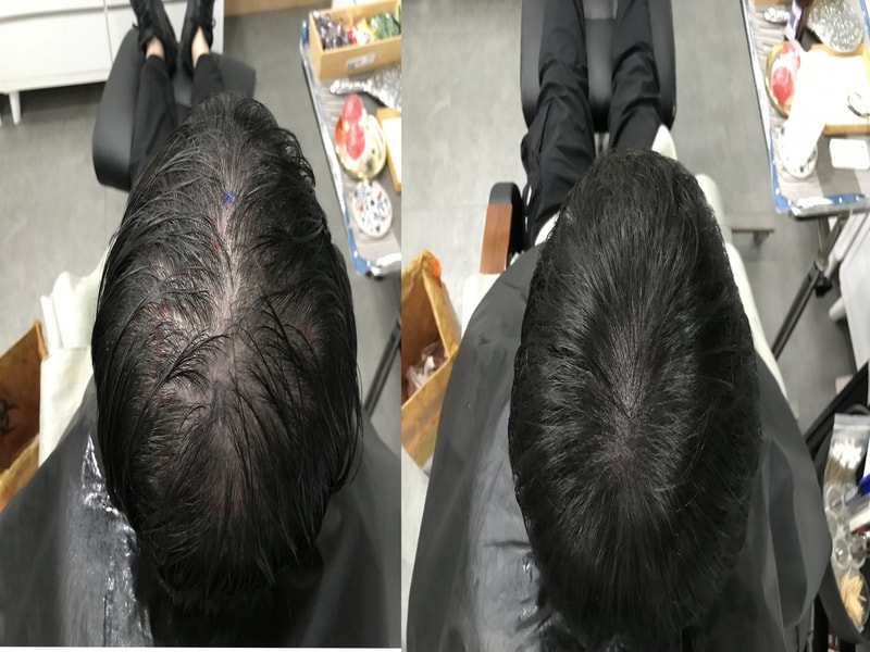 시술전후.jpg