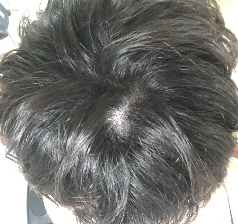 시술 당일저녁(조명).jpg