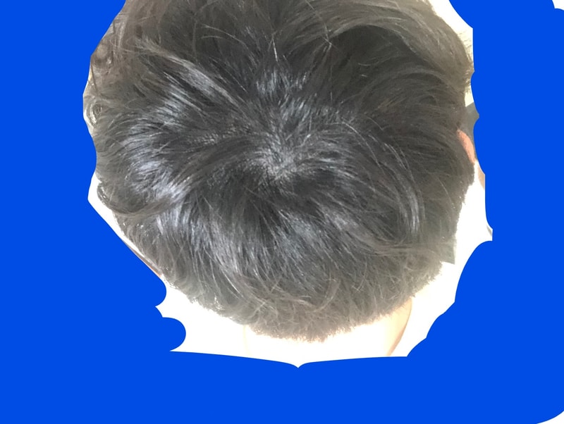 시술3일차 조명.jpg