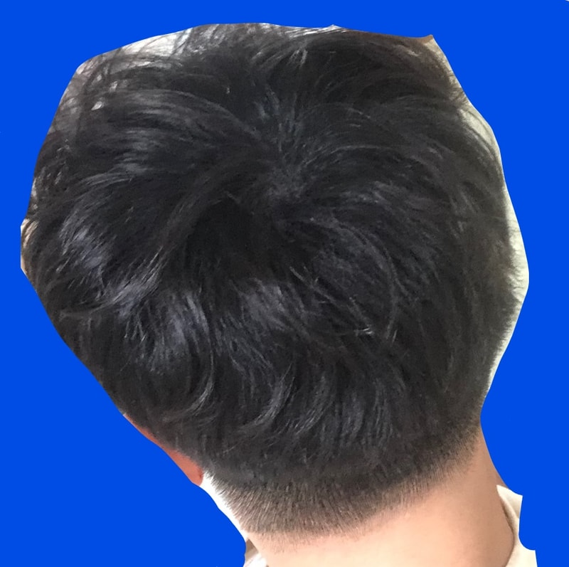 시술 3일차 일반.jpg