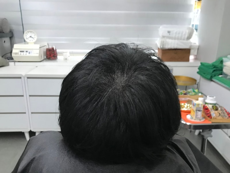 시술후 마른머리.jpg