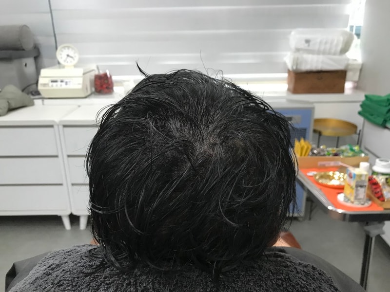 시술후 젖은머리.jpg