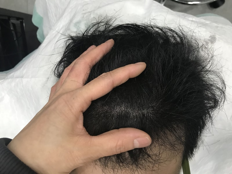 문신 후.jpg