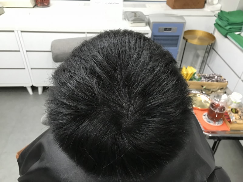 시술후_마른 머리.jpg