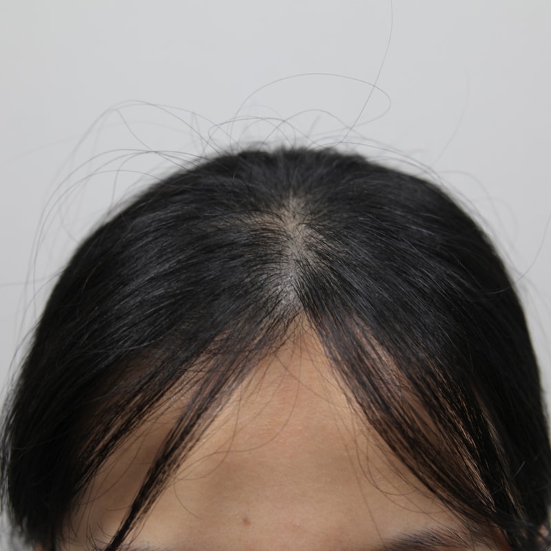 모나라두피문신_강남두피문신_두피문신피부과 3.jpg