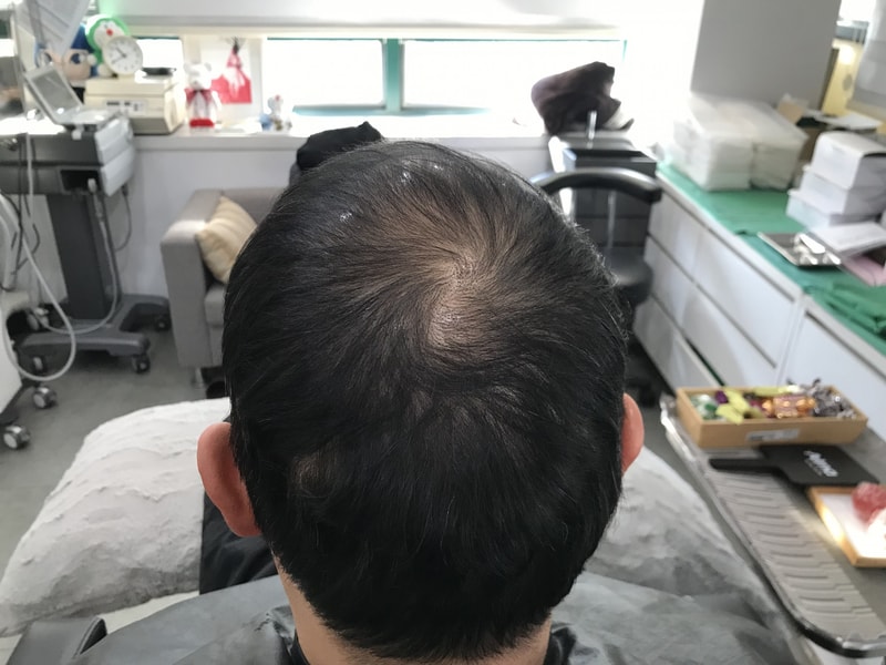 연세미다인 그라데이션 두피문신 1차 후기