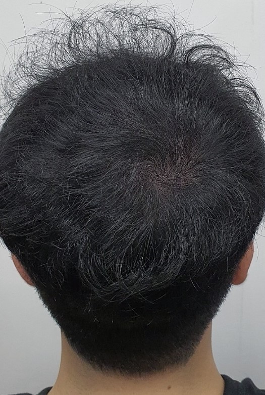 시술후.jpg