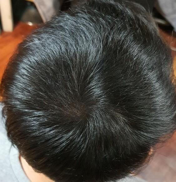 시술후 2.jpg